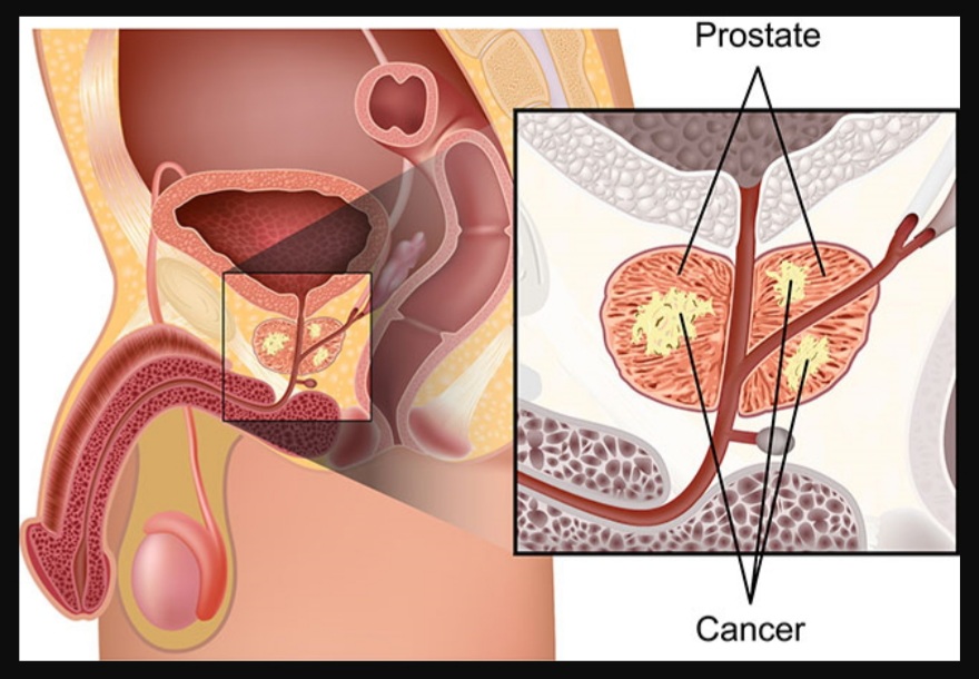 Pengobatan kanker prostat di Sunway Medical Centre